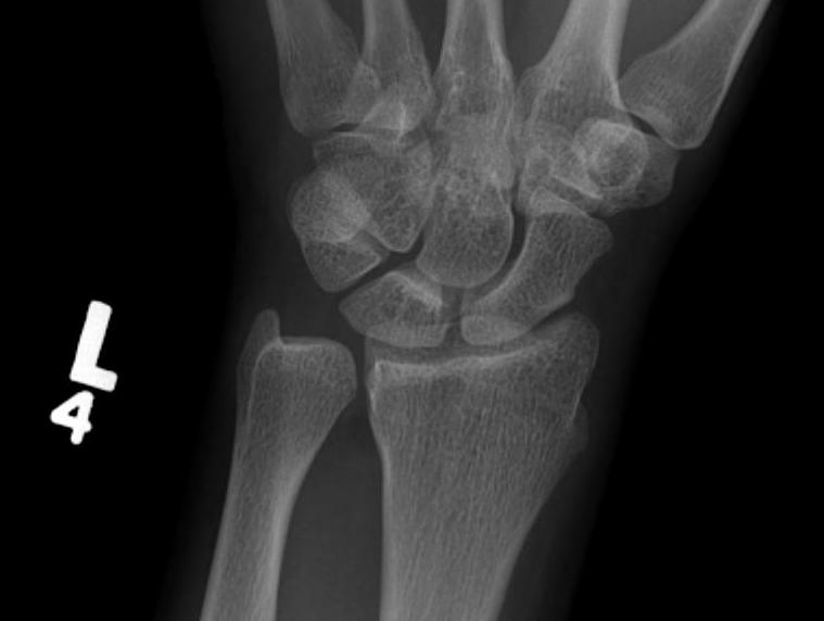 Ulna Variance Positive